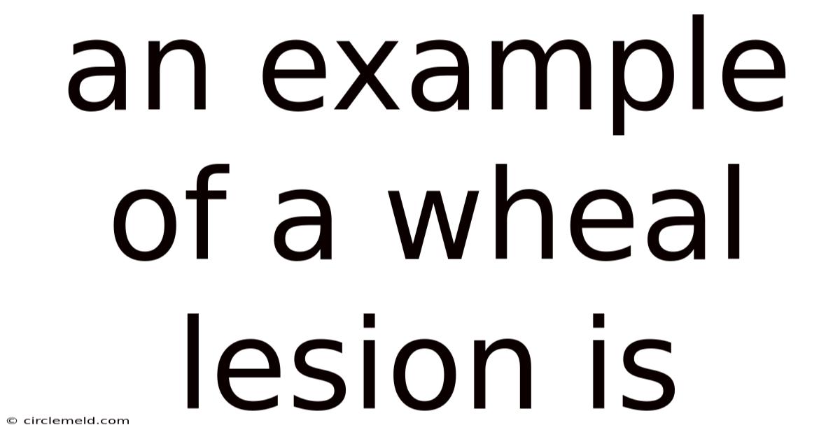 An Example Of A Wheal Lesion Is